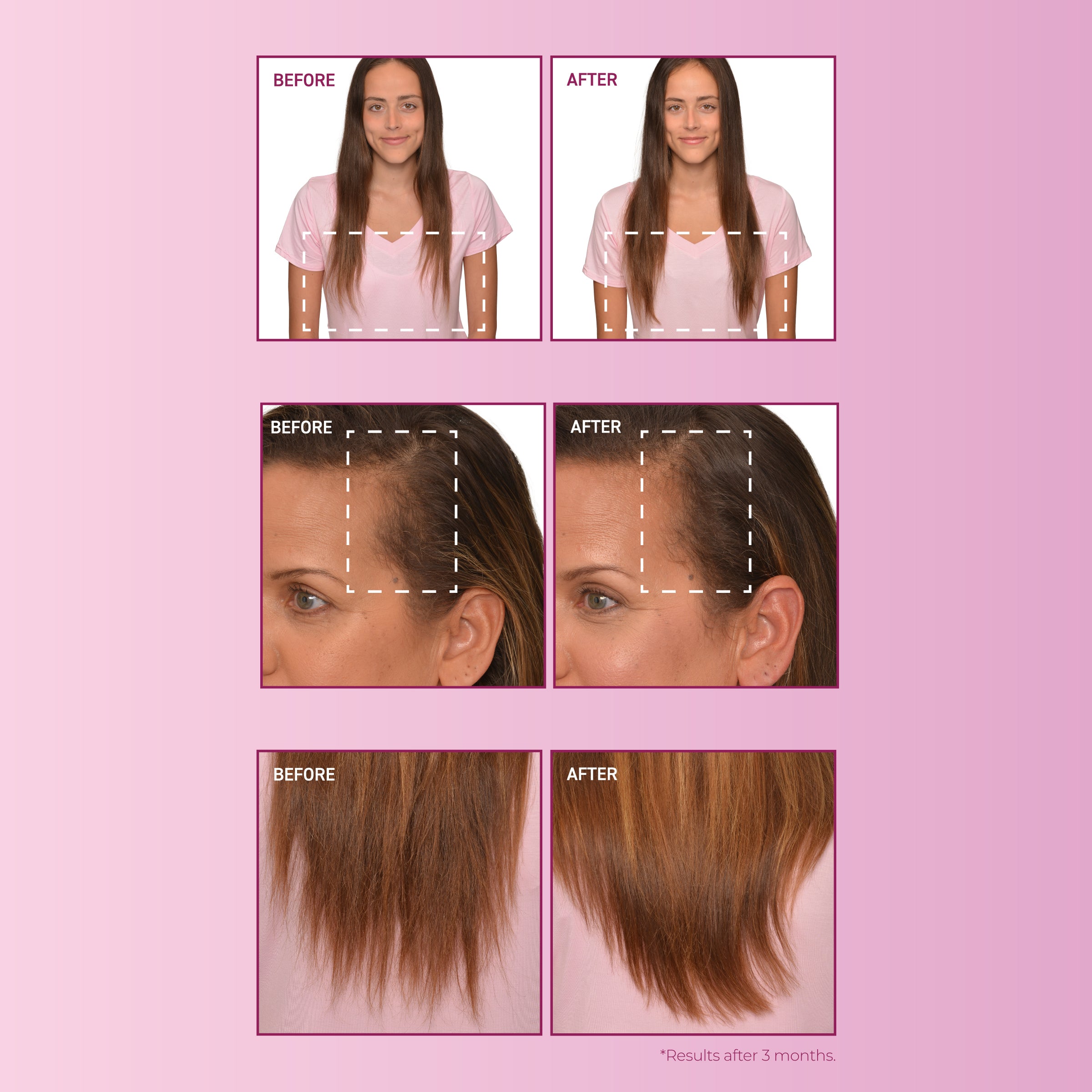 Before and after images of female hair regrowth.